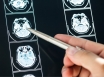 Aussie trial offers hope for brain cancer